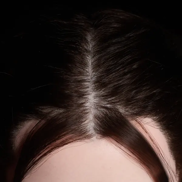 Cabelo implantado
