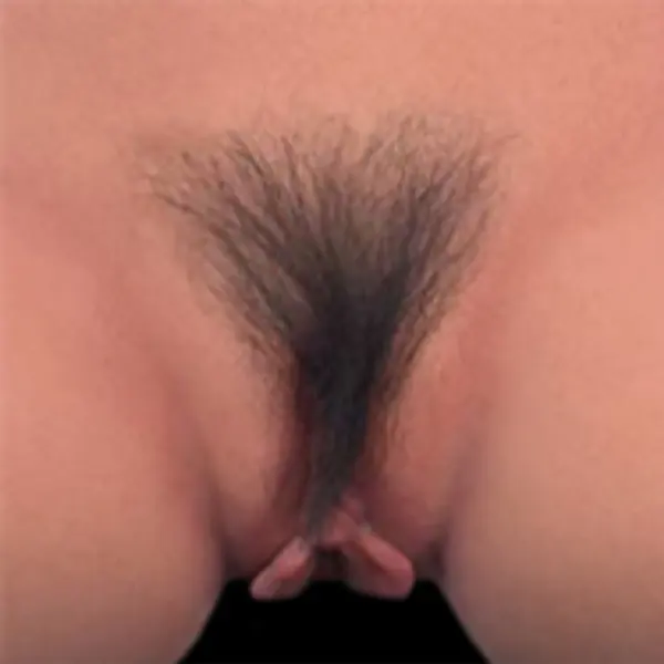 Pelos púbicos implantados